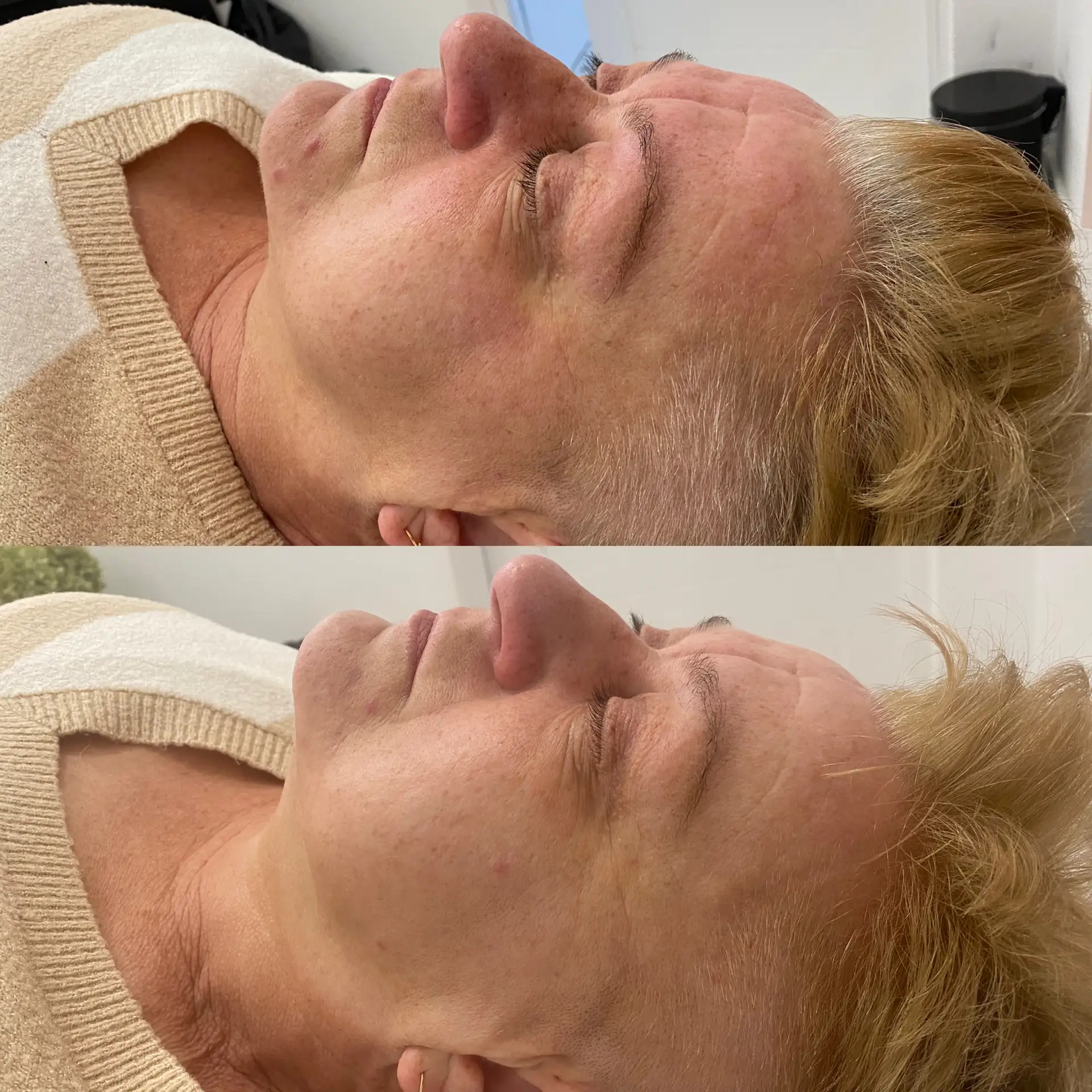 Efekty terapii promienna i zdrowa skóra Płock