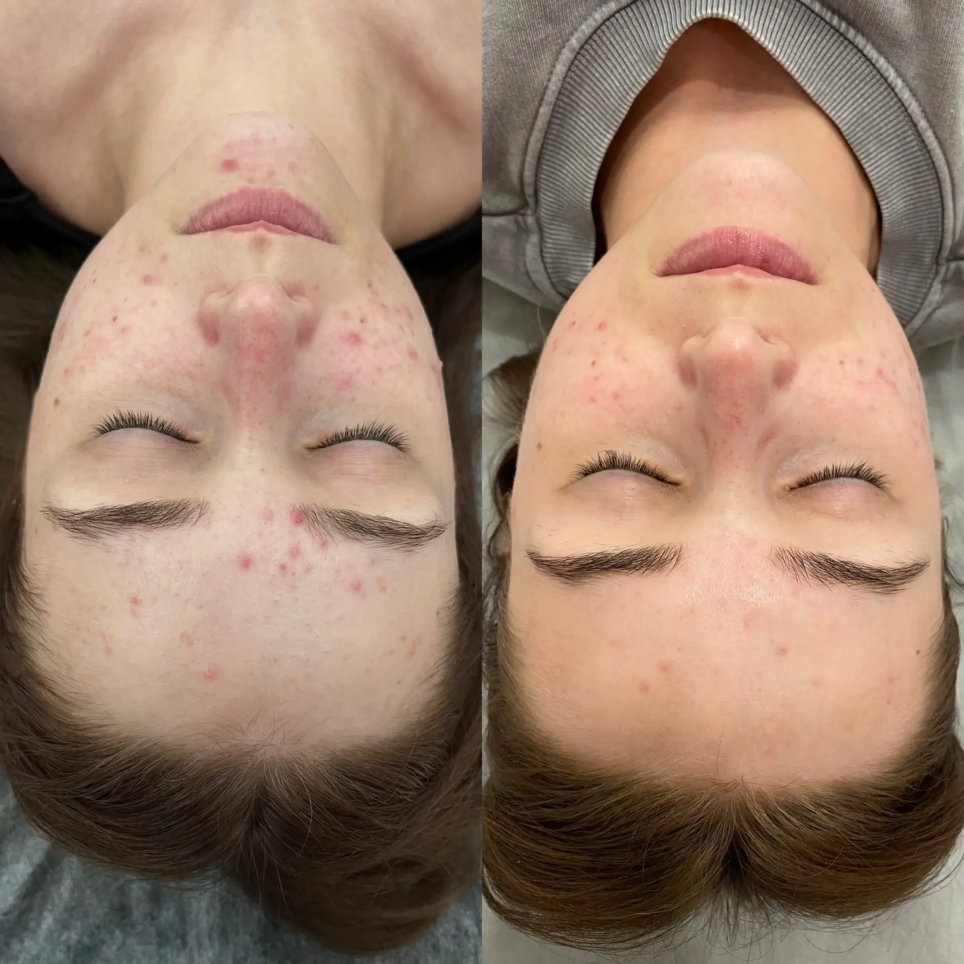 Efekty terapii przed i po zabiegiem w Płocku