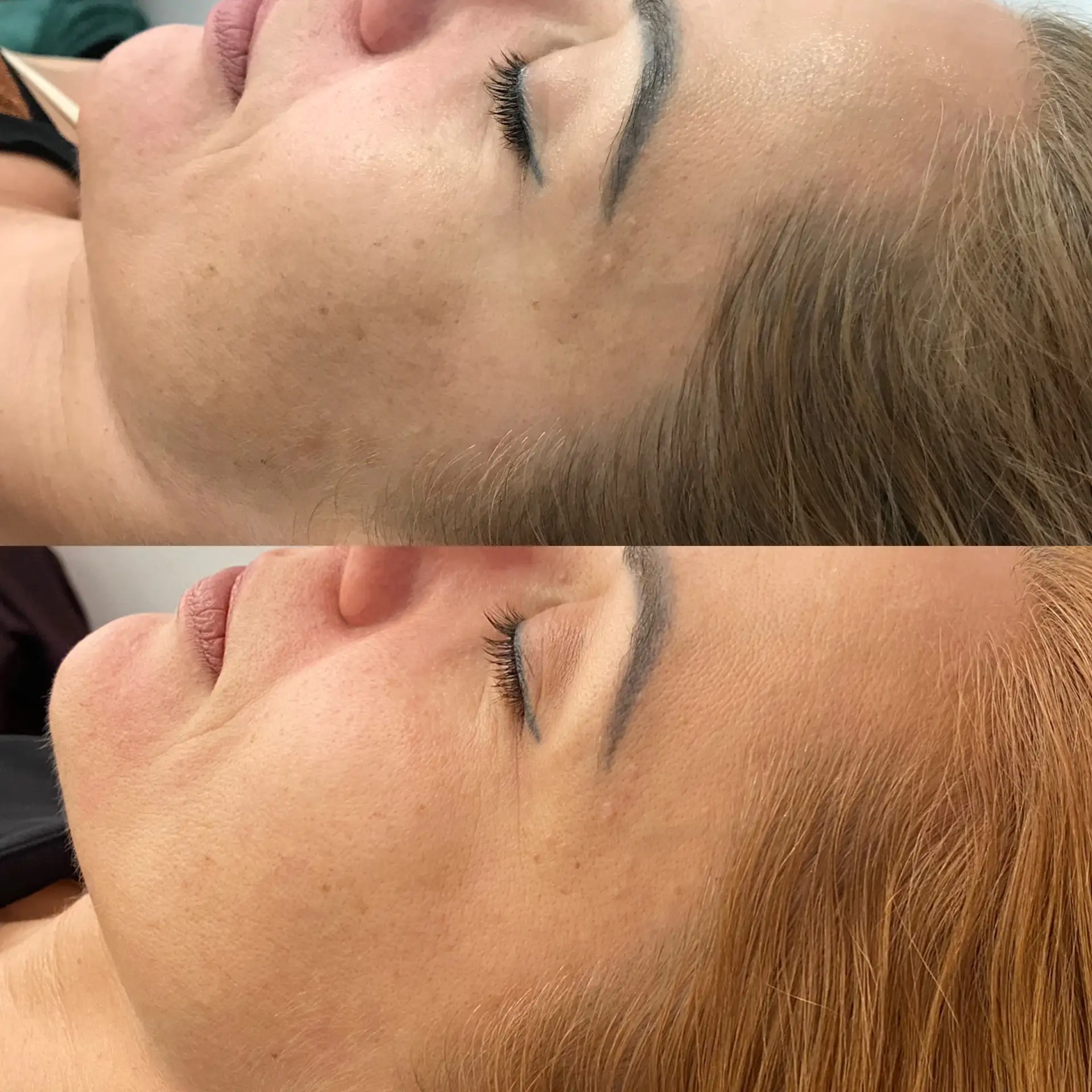 Efekty zabiegu kosmetologicznego przed i po Płock