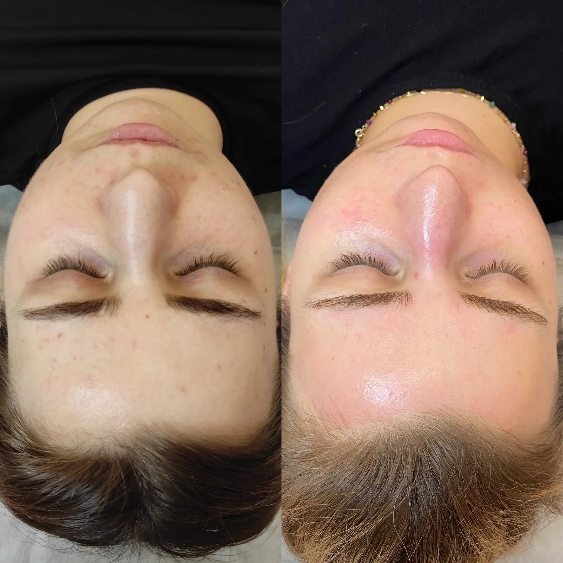 Terapia skóry przed i po w Beauty Studio Płock