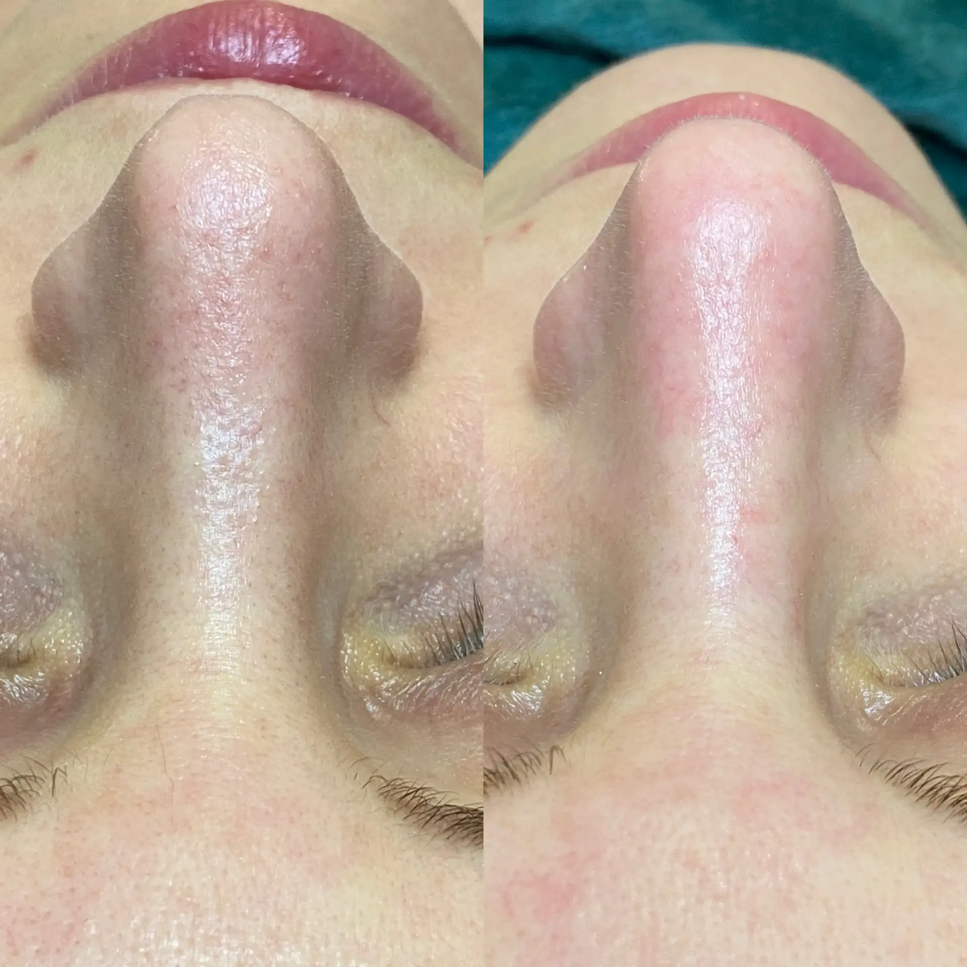 Zabieg anti-aging odmłodzenie rewitalizacja Płock